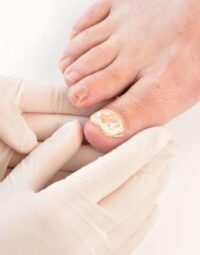 Kojų nagu grybelis ir kitos nagų ligos