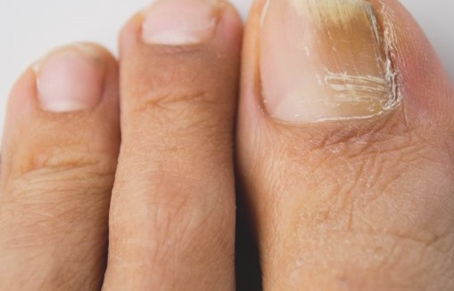 Kaip gydomas kojų nagų grybelis, vaistai nuo kojų nagų grybelio
